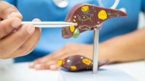 Fatty Liver Showdown: Is Alcohol-Related or Non-Alcoholic Liver Disease a Greater Threat?