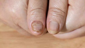 Health Alert: Brittle Nails Could Signal Hidden Illnesses – Iron Deficiency, Thyroid Issues, and More