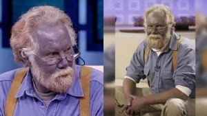 Skin Turns Blue-Gray? Understanding Argyria (Smurf Syndrome): Causes, Symptoms, and Prevention