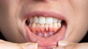 Peppermint Oil: A Natural Powerhouse for Optimal Oral Health and Hygiene
