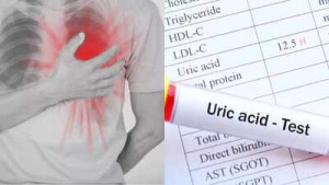 Uric Acid Alert: Elevated Levels Linked to Increased Heart Attack Risk