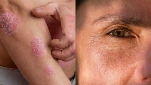 Smoking's Toll on Your Skin: 16 Ways Tobacco Ruins Your Complexion