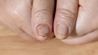 Brittle nails could be a sign of serious health problems: Causes and underlying conditions explained