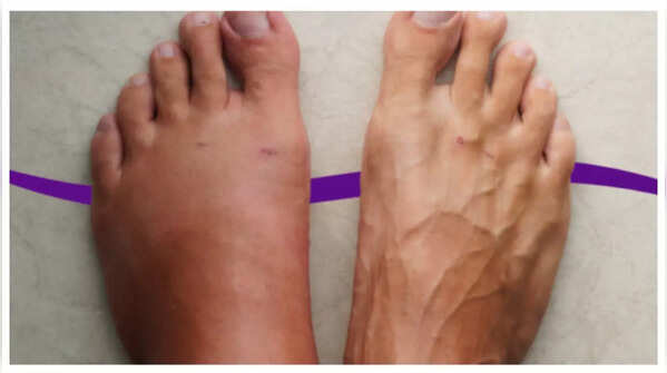 Swelling in the legs, ankles, or abdomen