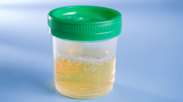Foamy or bubbly urine