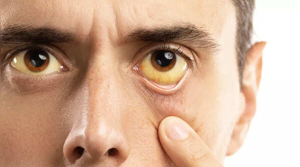 Yellowing of the skin and eyes