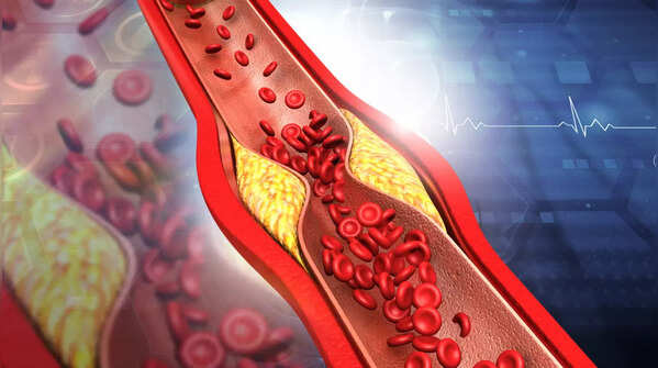 High cholesterol levels