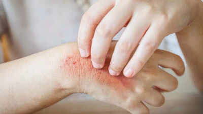 How diabetes affects the skin: 10 skin problems caused by diabetes you should know about