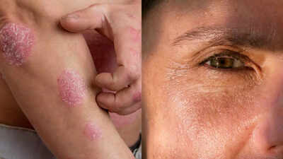 How smoking affects the skin: 16 side effects and risks you should know