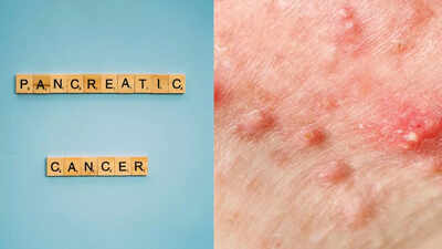 Pancreatic symptoms on skin: Early signs you shouldn’t ignore